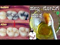 Hallu Novige Mane Maddu | Hallu Novu Home Remedies in Kannada | ಹಲ್ಲು ನೋವಿಗೆ ಮನೆಮದ್ದು | Teeth Pain
