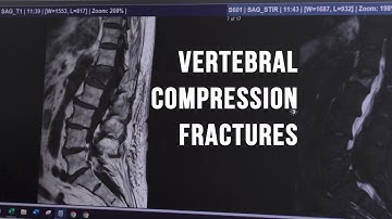 How to Identify Vertebral Compression Fractures