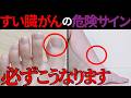 【医師監修】知らないと後悔する「すい臓がんの足の危険サイン」症状から予防法まで徹底解説