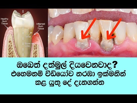 දත් ටික ඕන නම් දත් මුල් දියවීම මුල් අවස්තාවේම හදුනා ගන්න  - how to get rid of gum disease