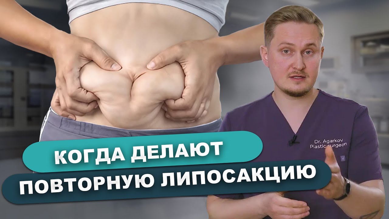 Когда нужна Повторная Липосакция. - YouTube