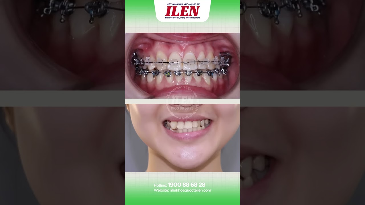 Đường giữa lệch &ndash; Niềng răng c&oacute; khắc phục được kh&ocirc;ng 🤔 #nhakhoaquocteilen #ilen #chinhnha #niengrang