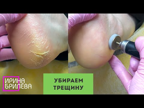 Глубокая ТРЕЩИНА НА ПЯТКЕ 🌸 Педикюр 🌸 Ирина Брилёва