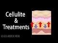 Cellulite and Treatment Options (incl. Cellulaze), Animation.