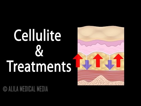 Vidéo: Cellulite: Causes, Symptômes, Traitements Et Images