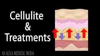 Cellulite and Treatment Options (incl. Cellulaze), Animation. screenshot 2