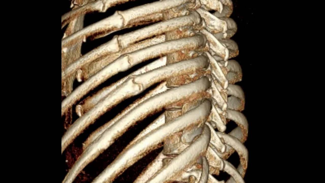 Грудная клетка человека. Реберный хрящ. 13 ребро у человека. 1. Форум ребрах.