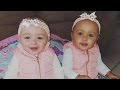 Twin babies have different skin colors