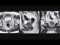 Routine prostate cancer screening over 45: Act now