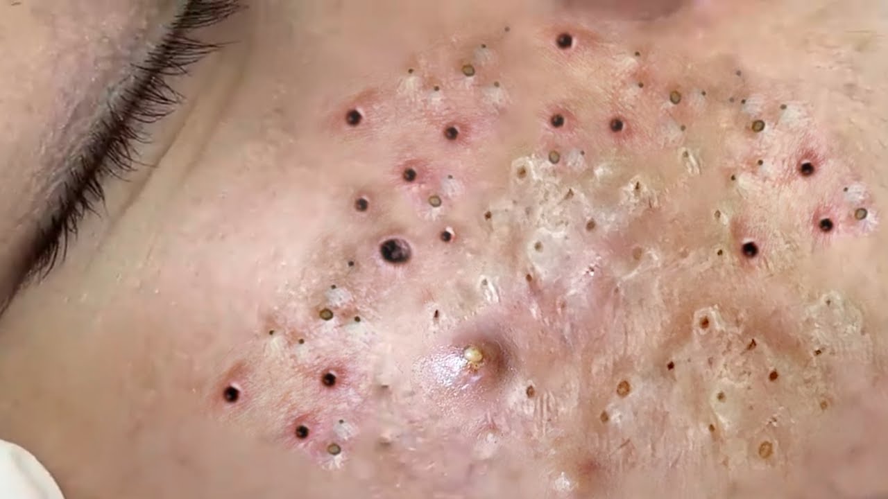 Blackhead Treatment On Cheeks At Sac Dep Spa Youtube