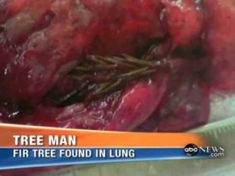 Thumb of Russian Surgeons Found A Two-Inch Fir Tree Growing In This Man's Lungs video