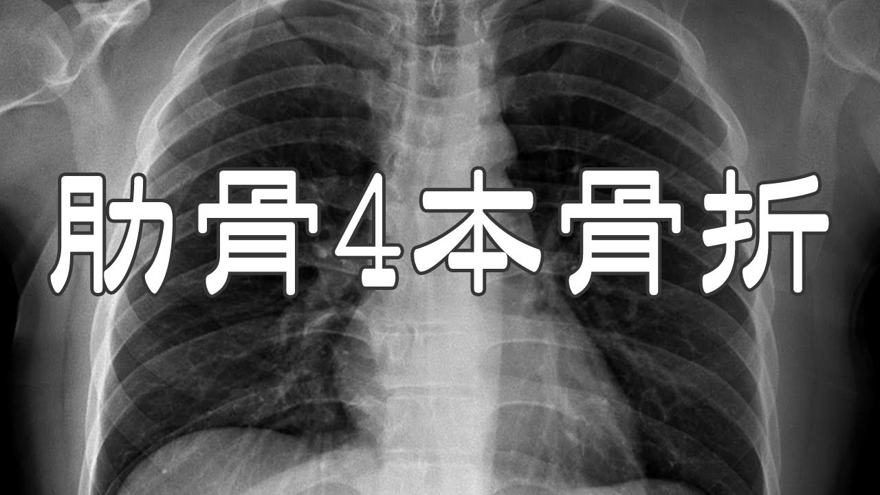 肋骨骨折報告 コケて肋骨を4本折りましたので 近況報告 治療代と薬代も公開 Youtube