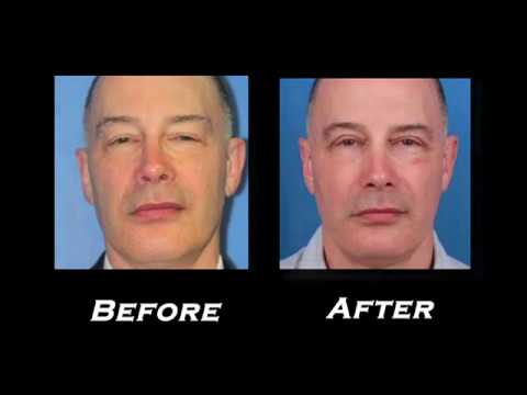 Upper Eyelid Surgery Patient Testimonial with Dr. Philip Miller