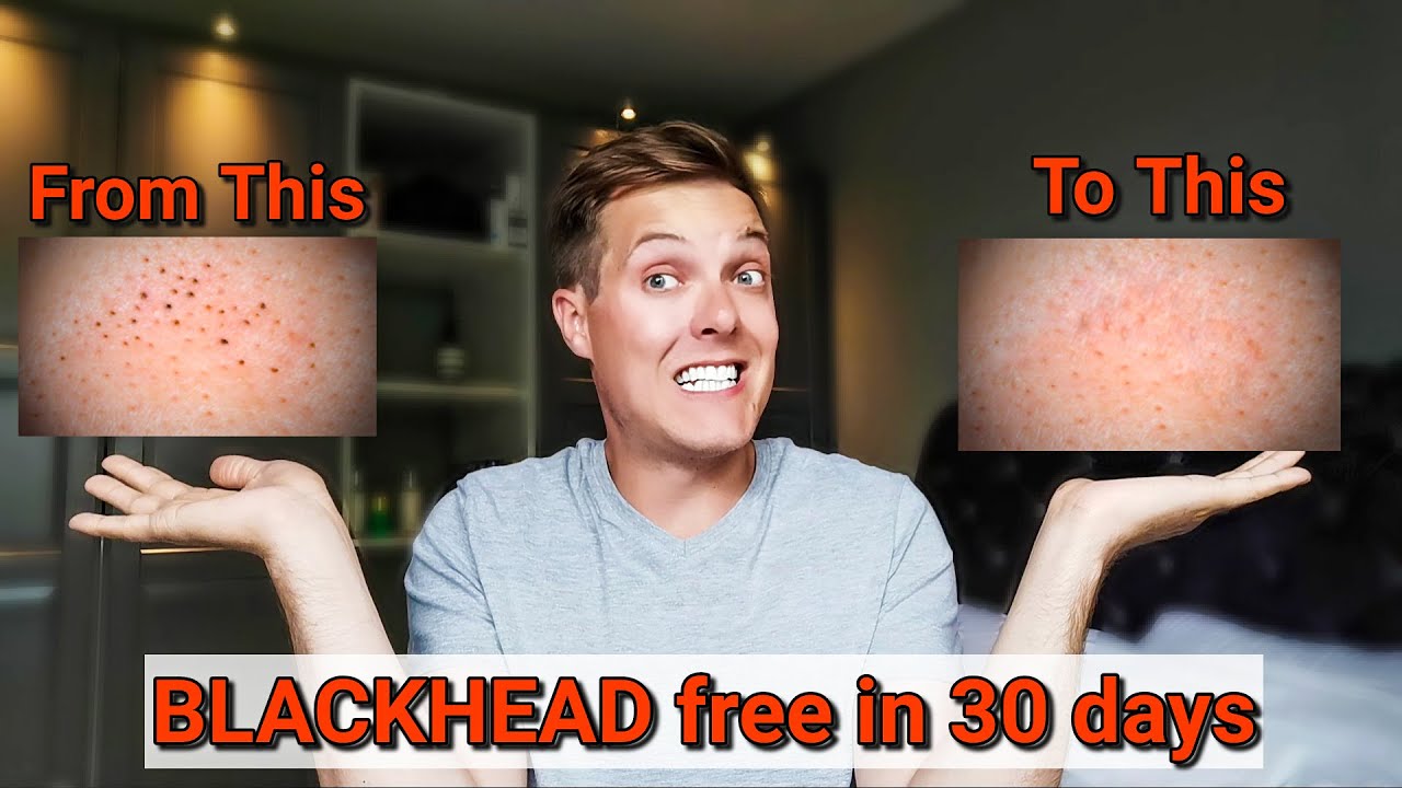 ERADICATE BLACKHEADS 30 day skincare routine for smaller pores and