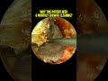 Why This Patient Need 6 MONTHLY Earwax Cleaning?