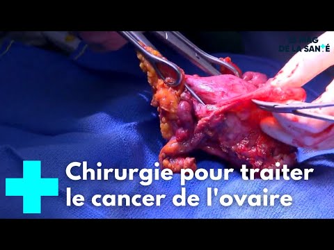 Vidéo: Comment traiter le cancer de l'ovaire : 13 étapes (avec photos)