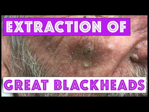Blackheads Or Sebaceous Filaments On The Nose? Extractions