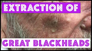 Blackheads or Sebaceous Filaments on the Nose? Extractions