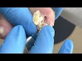 Professional pedicure:Toenails grow into triangles, what happens when you prune