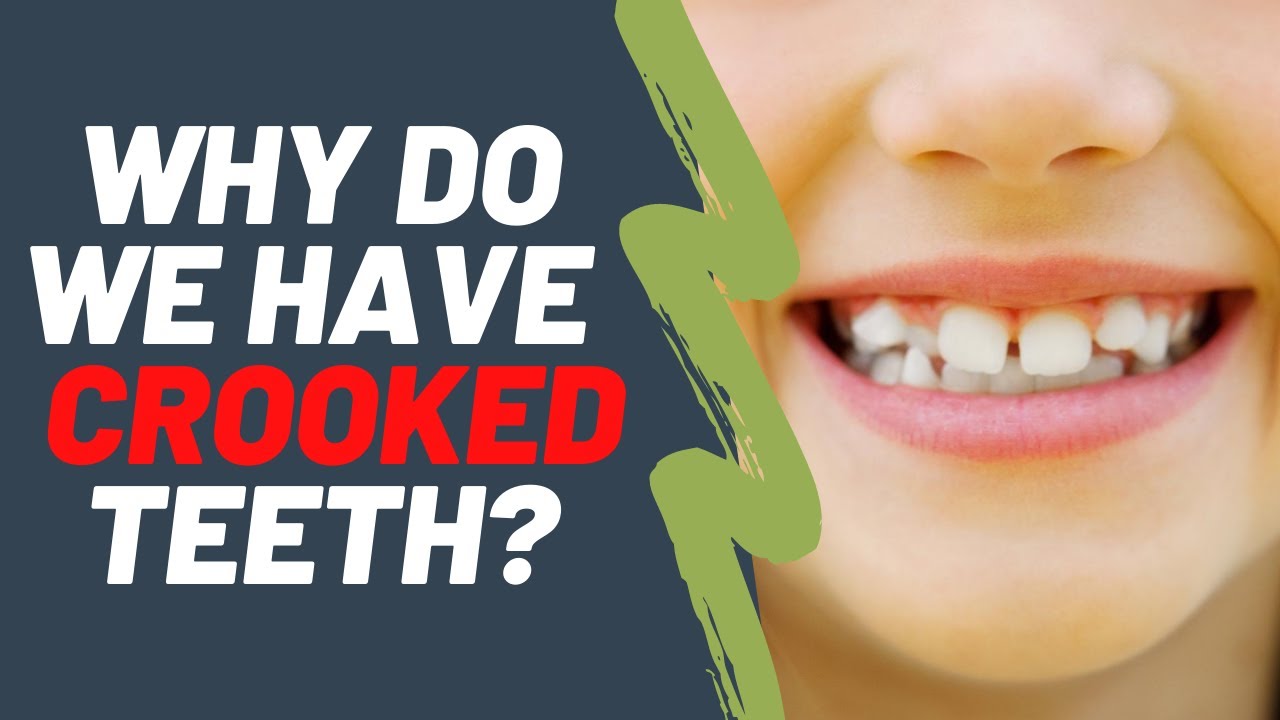 causes of crooked teeth, how to fix crooked teeth, crooked teeth, teeth...