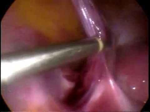 Ooforectomia por video / Video Oophorectomy 