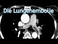 Die Lungenembolie