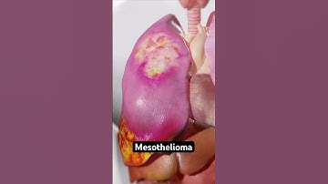 How asbestos causes cancer (3D Animation)