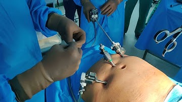 Robotic TAPP (rTAPP) Meshplasty - Large Mesh Insertion Technique