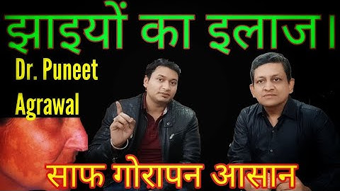 गोरापन, साफ रंग, झाइयां दूर करने के क्रीम और इलाज  Dr Puneet Agrawal #SuccessG Jhaiya #Melasma
