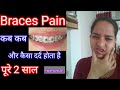 |Braces pain|कबकब और कैसा दर्द होता हैपूरा 2साल अपना अनुभव आपके साथ शेयर करना चाहूंगीDo Braces hurt?