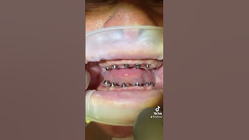 Go ahead and tag @Thebentist 😅 | Multiunit Abutments on Dental Implants - No Teeth #aprilfools