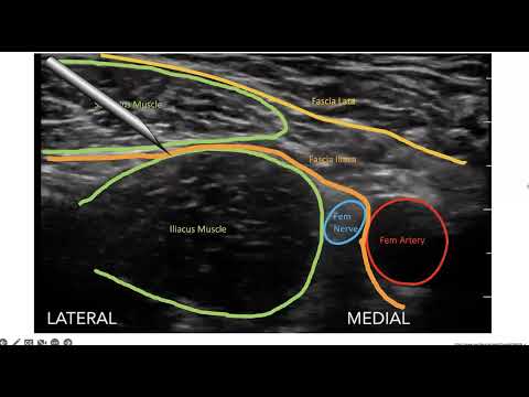 Ultrasound Guided Fascia Iliaca Block