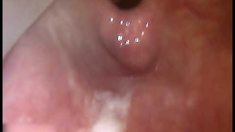 Poor laryngoscopic technique could be catostrophic from AOD