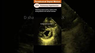 Paradoxical Septal Motion