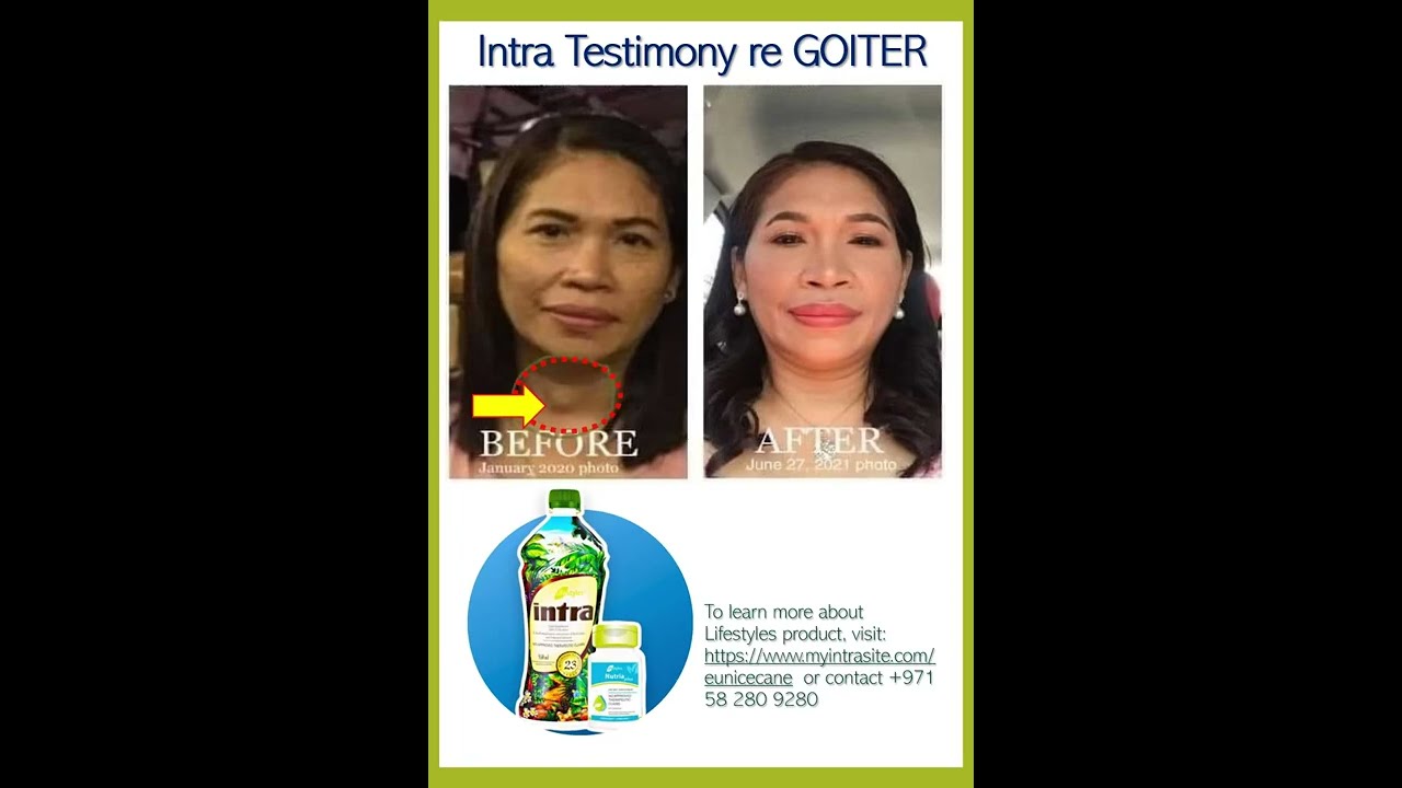 INTRA Testimony re GOITER. PLS LIKE 👍🏻 and SUBSCRIBE_Thank you 🙏🏻🇦🇪🇦🇪🇦🇪