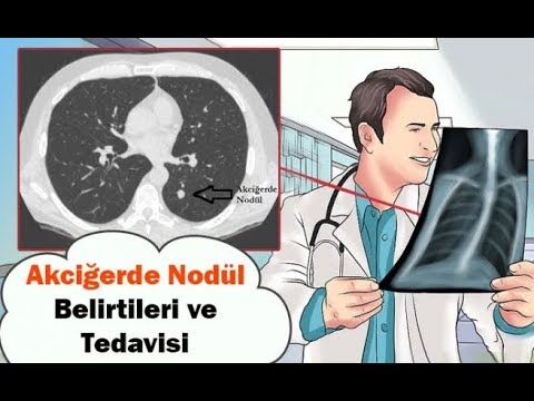 AKCİĞER KİSTLERİ NASIL TEDAVİ EDİLİR?