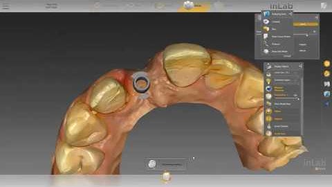 Ti-base implant restoration - Model builder with analog  - Dentsply Sirona Inlab 18.1