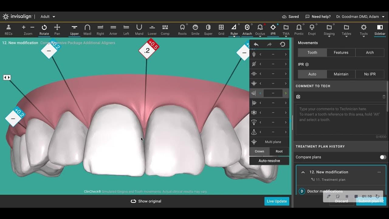 What is Misunderstood about Interproximal Reduction IPR in conjunction