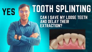 Dr Rudra Mohan | Can I Save my loose teeth ? Find out here ! Periodontal/Tooth Splinting