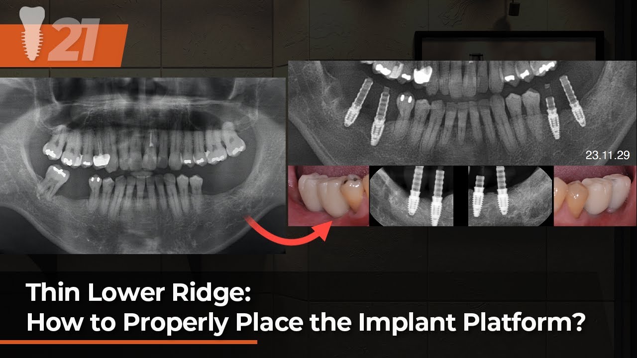 Thin Lower Ridge: How to Properly Place the Implant Platform? - YouTube