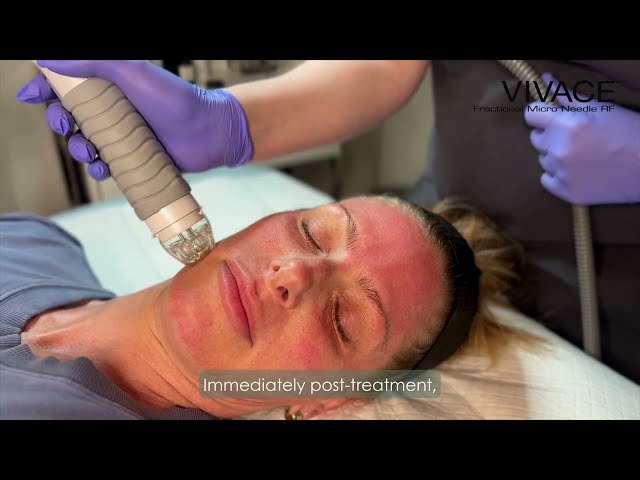 Vivace RF Microneedling Demonstration
