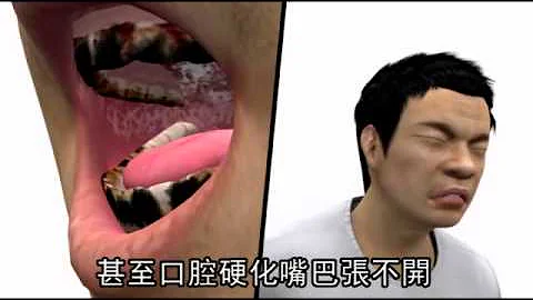 口腔癌患者 9成嚼槟榔--苹果日报 20141126 - 天天要闻