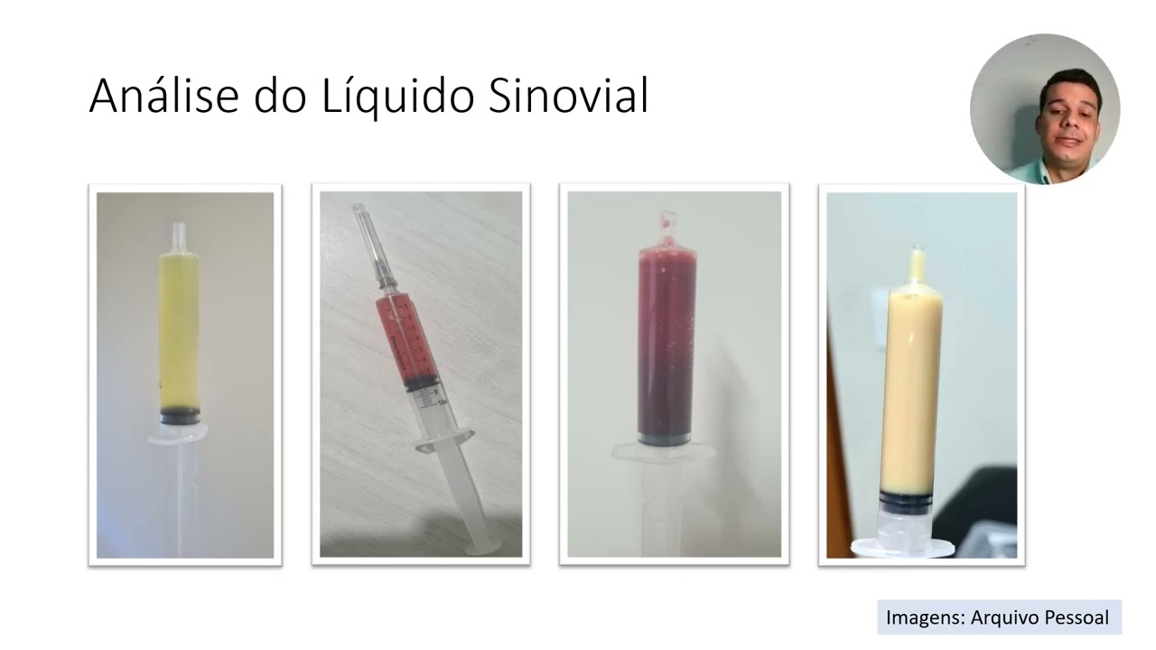 07 - Monoartrites Agudas e Crônicas