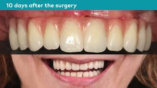 All-on-4® treatment concept case | Failing dentition in the maxilla