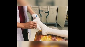 KAFO casting #KAFO #orthoticsandprosthetics #orthotics #2023