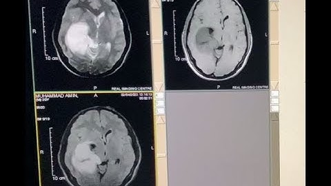 MRI Brain Plaining and Protocols || Contrast, DWI and ADC || on open MRI (0.3 Tesla)