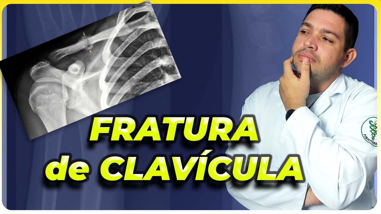 VOCÊ TEM FRATURA NA CLAVÍCULA? ENTÃO PRECISA VER ESSS VÍDEO