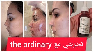 the ordinary peeling تجربتي مع المقشر الاحمر