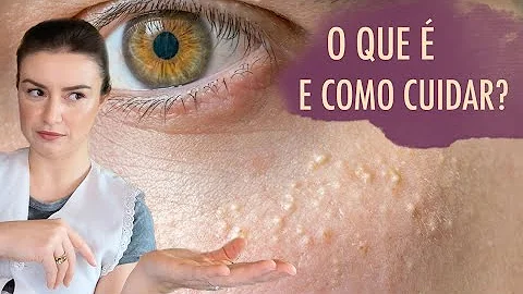 O que fazer para diminuir milium?