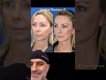 Huge reveal astonishing facelift results to look 20 years younger